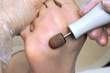 専用のマシーンを使用し、たこや厚くなった角質を削って除去していきます。角質化した部分は神経や血管などが通っていないので、削っても痛みは全くありません。