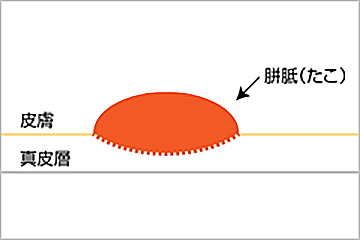 形状の分類：埋没型のイメージイラスト