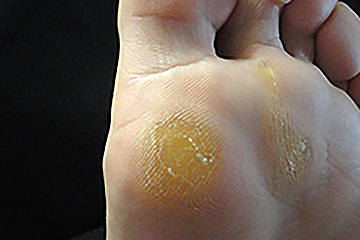 形状の分類：埋没型の写真