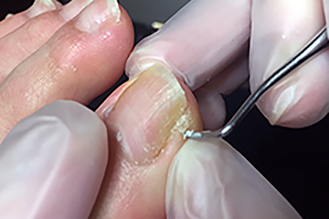 形状の分類：爪溝そうこう鶏眼（魚の目）の写真