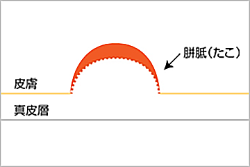 形状の分類：隆起型のイメージイラスト