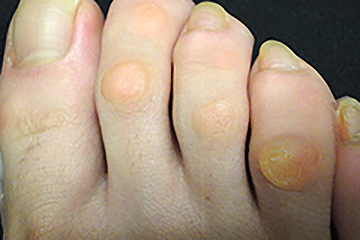 形状の分類：隆起型の写真